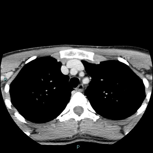 File:Cervical thymic cyst (Radiopaedia 88632-105335 C 6).jpg