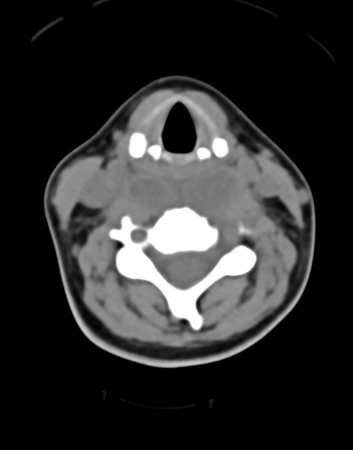 Cervical tuberculous spondylitis (Radiopaedia 39149-41365 Axial non-contrast 27).png