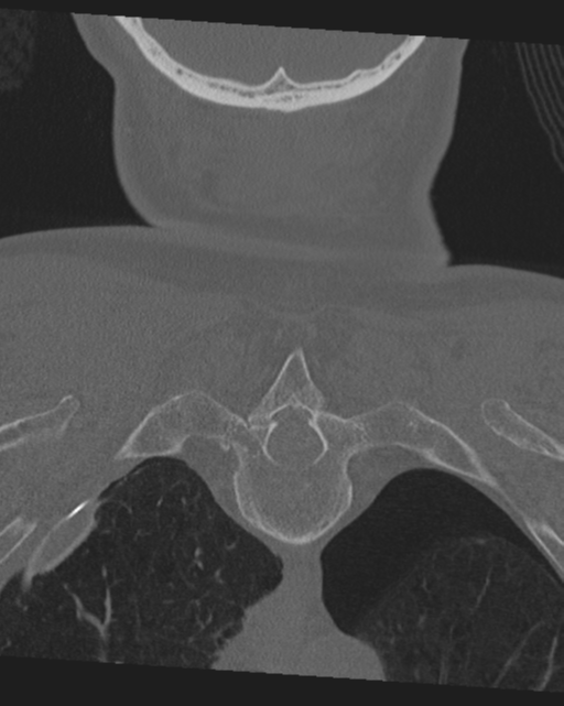 Chalk stick fracture (Radiopaedia 57948-64928 Coronal bone window 47).png