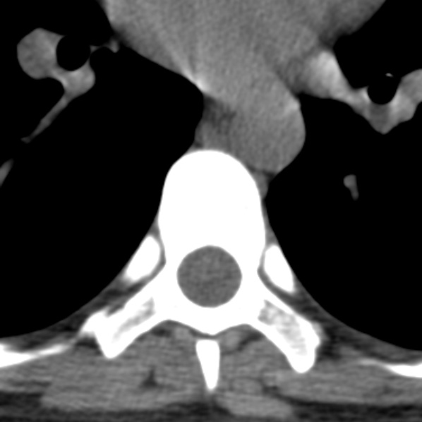 File:Chance fracture (Radiopaedia 36521-38081 Axial non-contrast 7).jpg