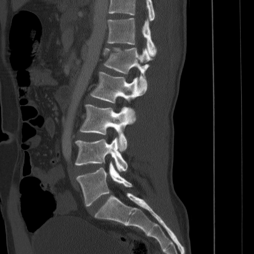 File:Chance fracture (Radiopaedia 7770-8592 Sagittal bone window 1).jpg