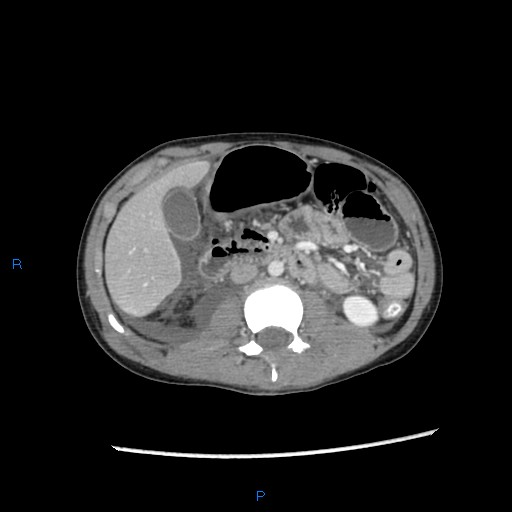 File:Chance fracture with duodenal and pancreatic lacerations (Radiopaedia 43477-46864 A 16).jpg