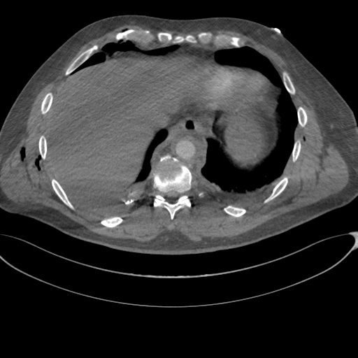 Chest multitrauma - aortic injury (Radiopaedia 34708-36147 A 238).png