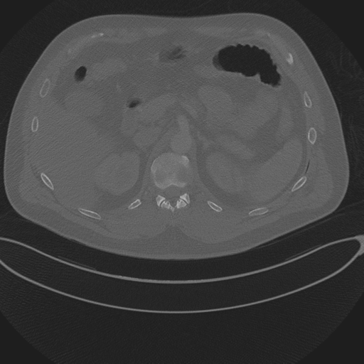 Chest multitrauma - aortic injury (Radiopaedia 34708-36147 Axial bone window 313).png