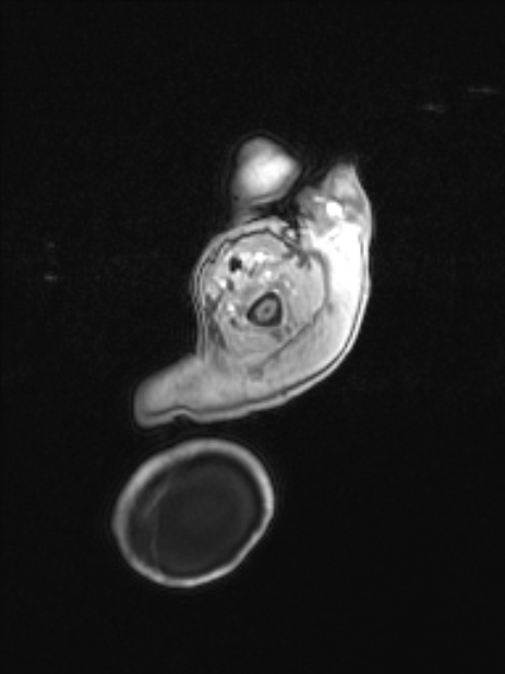 Chiari III malformation with occipital encephalocele (Radiopaedia 79446-92559 Axial T1 C+ mpr 13).jpg