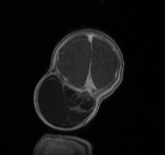 Chiari III malformation with occipital encephalocele (Radiopaedia 79446-92559 Coronal T1 C+ mpr 46).jpg
