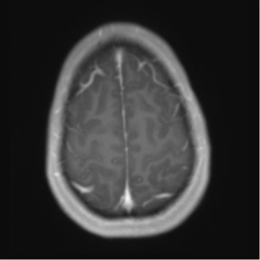 File:Chiari I malformation and obstructive hydrocephalus (Radiopaedia 41185-43978 Axial T1 C+ 27).png