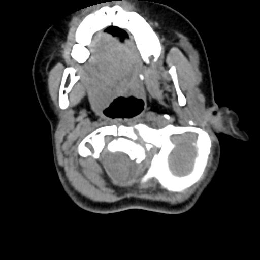 Chiari I with syrinx and skull base anomalies (Radiopaedia 89444-106412 Axial non-contrast 49).jpg