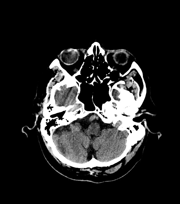 Cholangiocarcinoma with cerebral metastases (Radiopaedia 83519-98628 Axial non-contrast 18).jpg