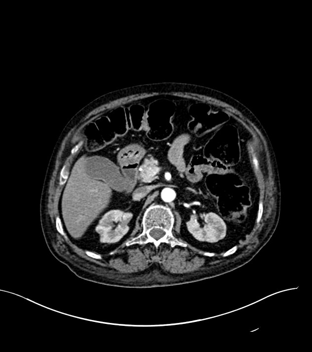 Cholangiocarcinoma with cerebral metastases (Radiopaedia 83519-98629 B 34).jpg