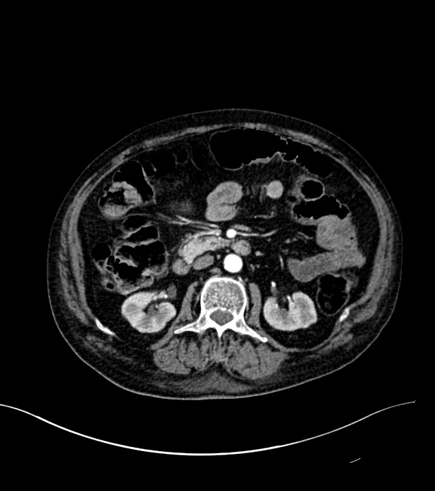 Cholangiocarcinoma with cerebral metastases (Radiopaedia 83519-98629 B 45).jpg