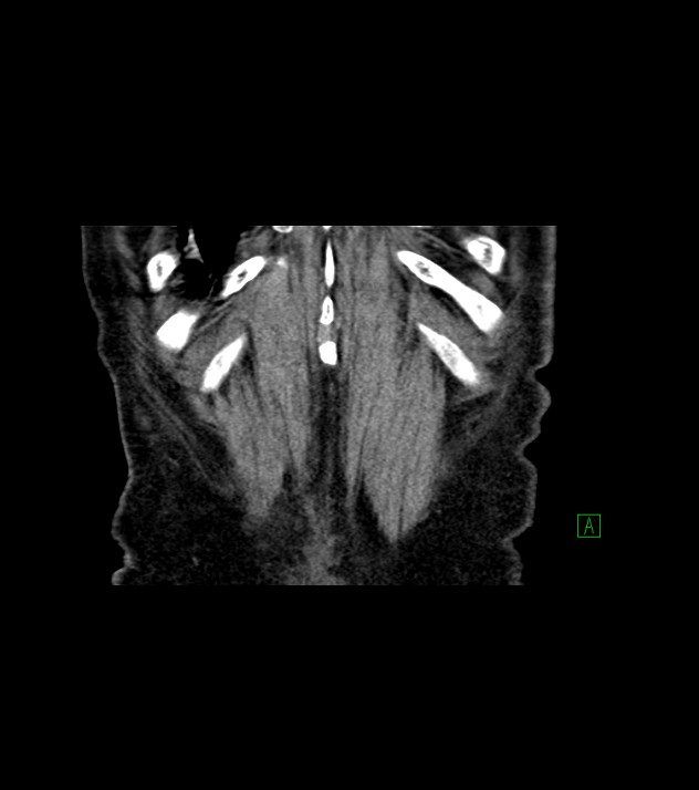 Cholangiocarcinoma with cerebral metastases (Radiopaedia 83519-98629 Coronal C+ delayed 77).jpg