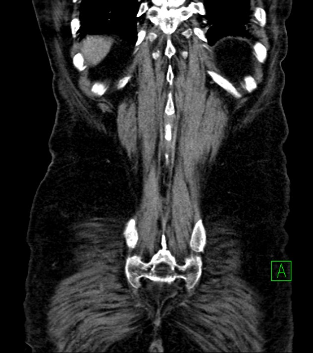 Cholangiocarcinoma with cerebral metastases (Radiopaedia 83519-98629 E 77).jpg