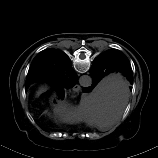 File:Cholecystitis - obstructive choledocholitiasis (CT intravenous cholangiography) (Radiopaedia 43966-47479 Axial 49).png