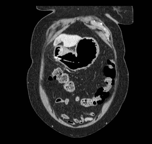 Cholecystoduodenal fistula (Radiopaedia 48959-54022 B 37).jpg