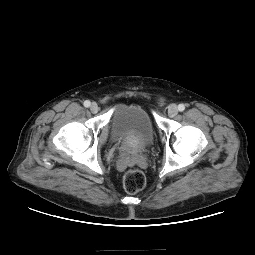 Choledocholiathiasis with normal caliber common bile duct (Radiopaedia 75368-86632 A 182).jpg