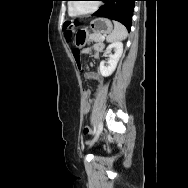 Choledocholithiasis on CT and MRI (Radiopaedia 24825-25087 D 43).jpg