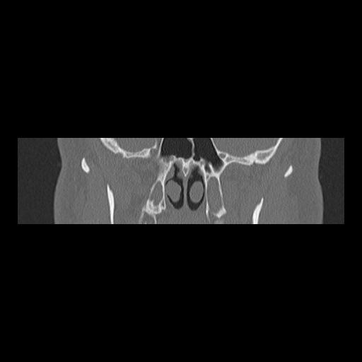 Cholesteatoma (Radiopaedia 84946-100455 Coronal bone window 64).jpg