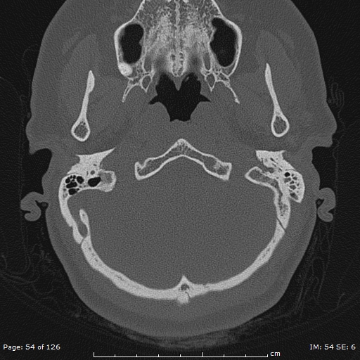 Cholesteatoma - external auditory canal (Radiopaedia 88452-105096 Axial bone window 17).jpg