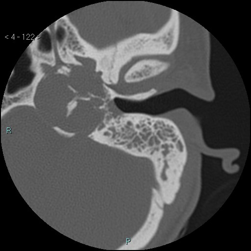 File:Cholesterol granuloma of the petrous apex (Radiopaedia 64358-73141 Axial bone window 59).jpg