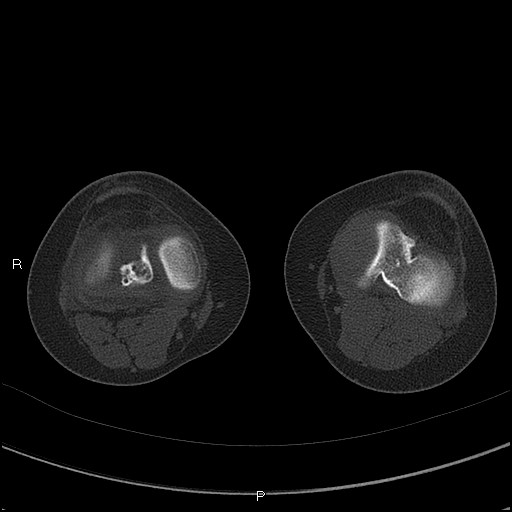 File:Chondroblastoma (Radiopaedia 62721-71030 Axial bone window 38).jpg