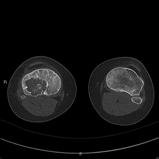Chondroblastoma (Radiopaedia 62721-71030 Axial bone window 56).jpg