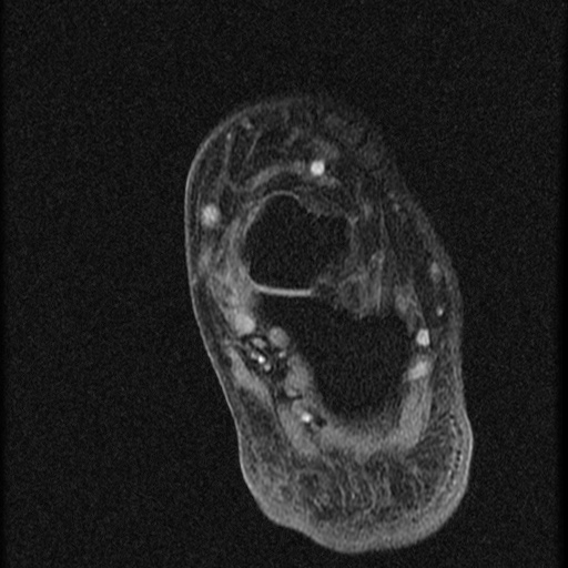 File:Chondroblastoma - midfoot (Radiopaedia 64831-73765 F 4).jpg
