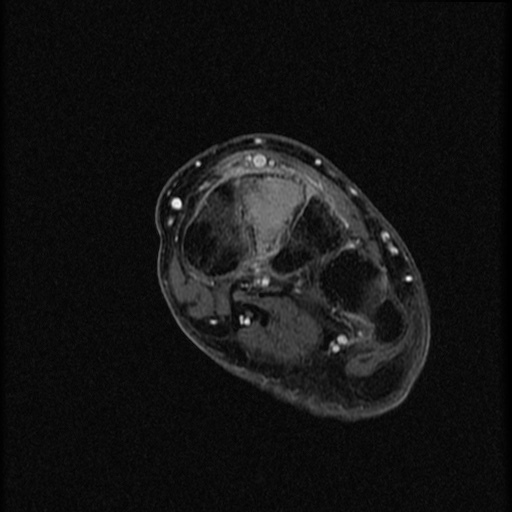 File:Chondroblastoma - midfoot (Radiopaedia 64831-73765 G 15).jpg