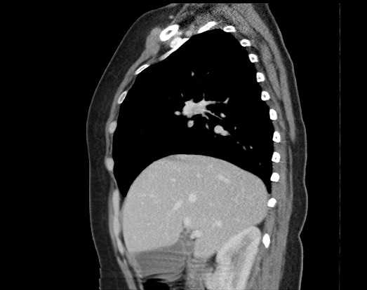 File:Chondrosarcoma - chest wall (Radiopaedia 65192-74199 B 40).jpg
