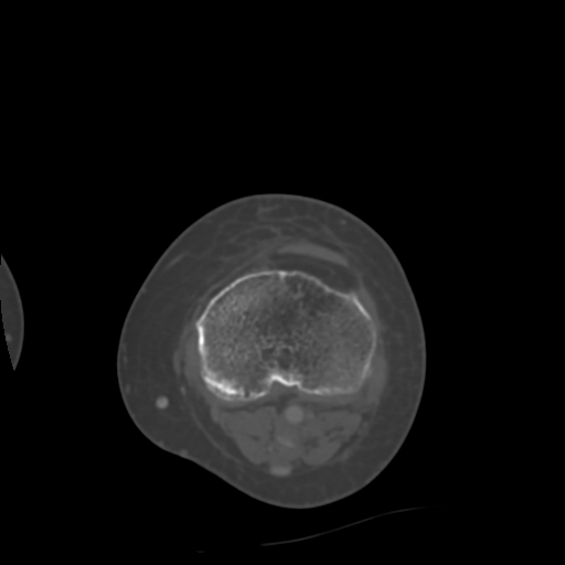 Chondrosarcoma - femur (Radiopaedia 64187-72954 Axial bone window 57).jpg