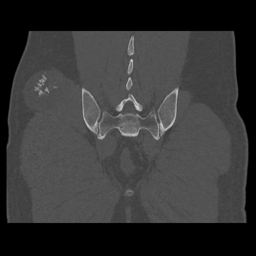 Chondrosarcoma of iliac wing (Radiopaedia 63861-72599 Coronal bone window 93).jpg