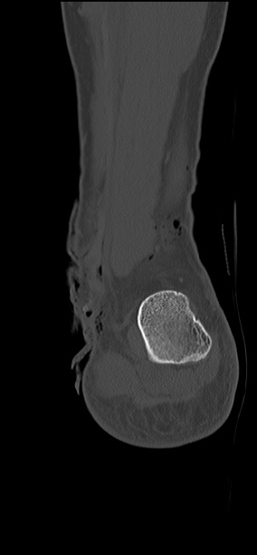 Chopart fracture (Radiopaedia 35347-36851 Coronal bone window 16).jpg