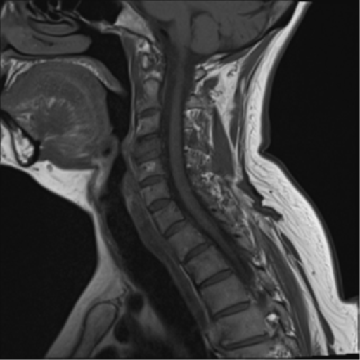 File:Chordoma (C4 vertebra) (Radiopaedia 47561-52189 Sagittal T1 5).png