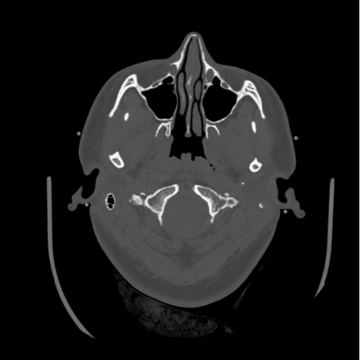 Choroid plexus papilloma extending into the cerebellopontine angle cistern (Radiopaedia 85941-101833 Axial bone window 17).png