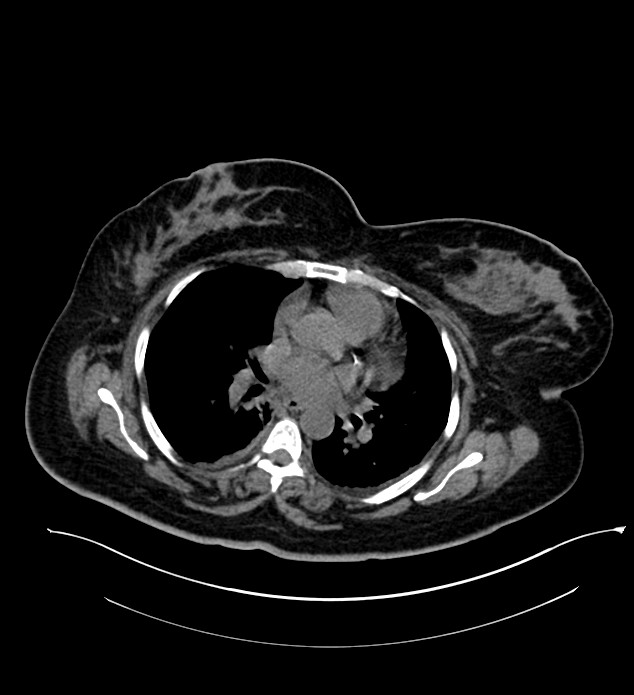 Chromophobe renal cell carcinoma (Radiopaedia 84239-99519 Axial non-contrast 5).jpg