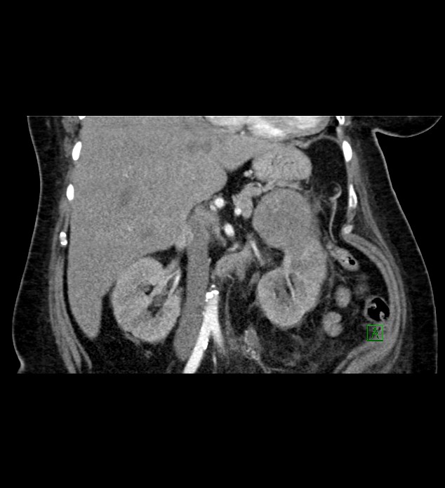 Chromophobe renal cell carcinoma (Radiopaedia 84239-99519 C 44).jpg