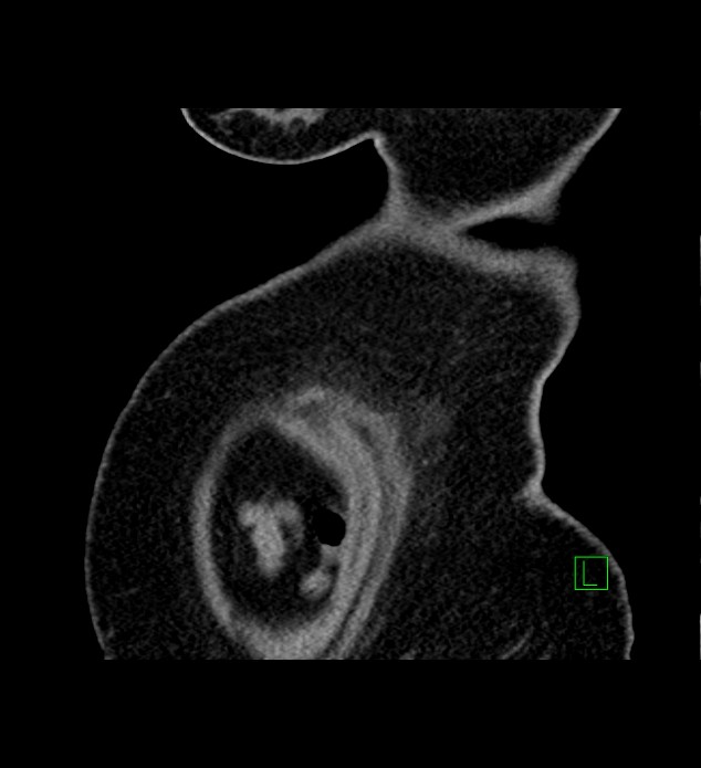 Chromophobe renal cell carcinoma (Radiopaedia 84239-99519 D 4).jpg