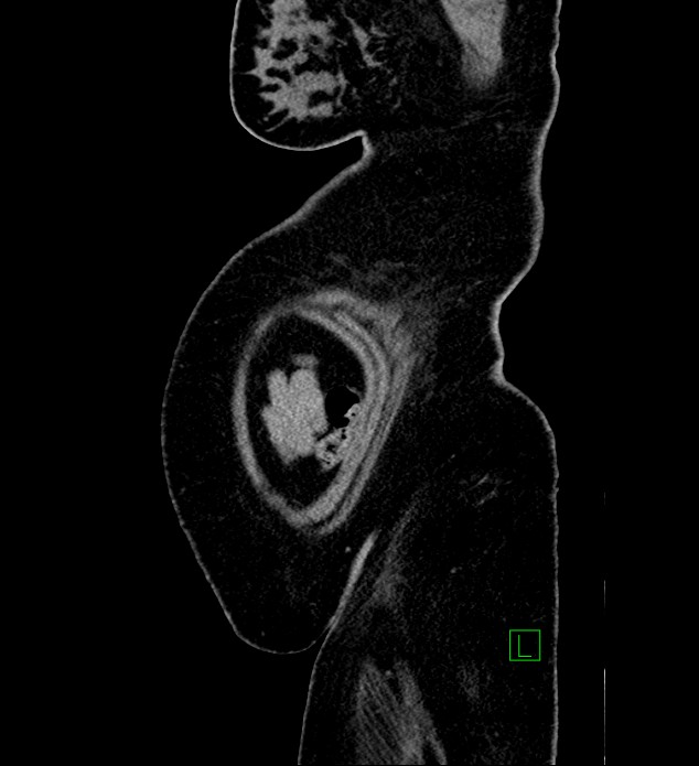 Chromophobe renal cell carcinoma (Radiopaedia 84239-99519 G 7).jpg