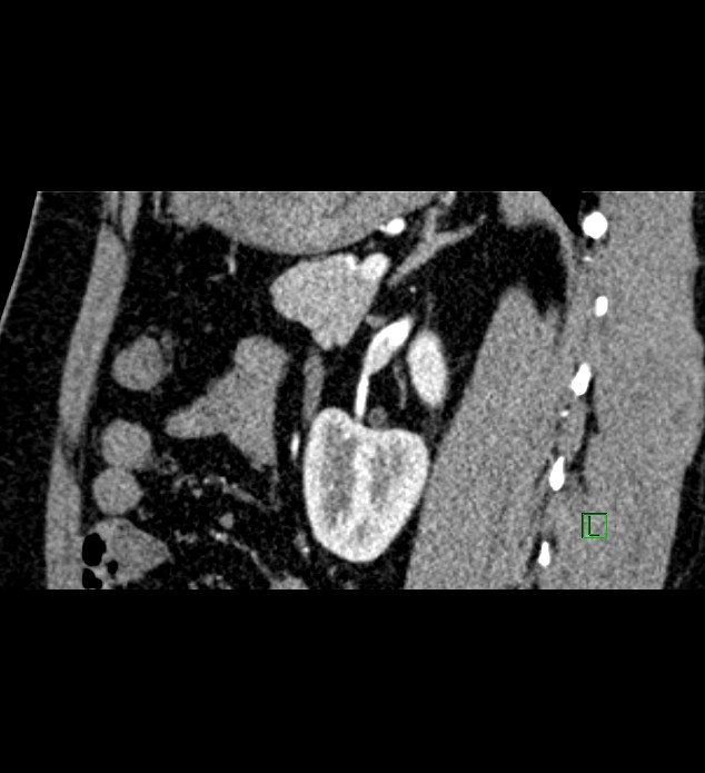 Chromophobe renal cell carcinoma (Radiopaedia 84286-99573 F 60).jpg