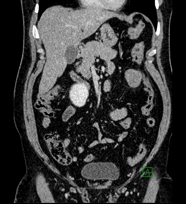 Chromophobe renal cell carcinoma (Radiopaedia 84286-99573 H 65).jpg