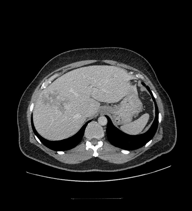 Chromophobe renal cell carcinoma (Radiopaedia 84337-99644 C 26).jpg