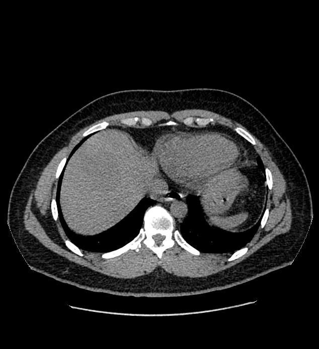 Chromophobe renal cell carcinoma (Radiopaedia 84337-99693 Axial non-contrast 4).jpg