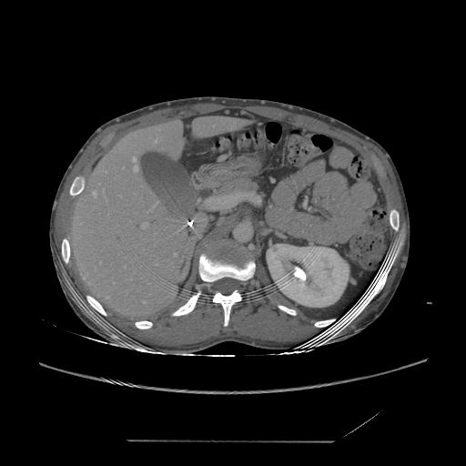 File:Chronic IVC thrombosis and resultant IVC filter malposition (Radiopaedia 81158-94800 A 58).jpg