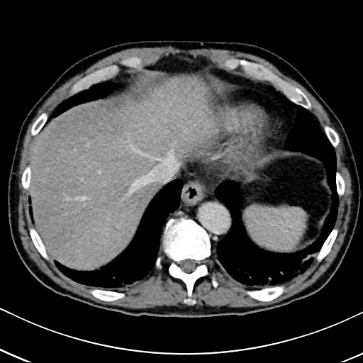 Chronic appendicitis complicated by appendicular abscess, pylephlebitis and liver abscess (Radiopaedia 54483-60700 B 27).jpg