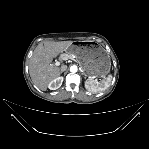File:Chronic contained rupture of abdominal aortic aneurysm with extensive erosion of the vertebral bodies (Radiopaedia 55450-61901 A 5).jpg