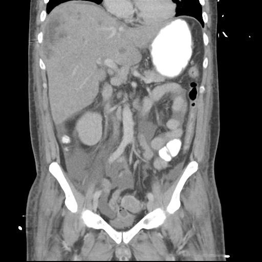 Chronic diverticulitis complicated by hepatic abscess and portal vein thrombosis (Radiopaedia 30301-30938 B 29).jpg