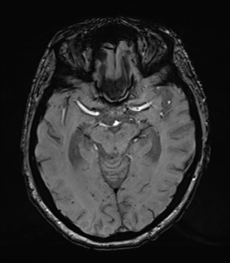 Chronic hypertensive encephalopathy (Radiopaedia 39993-42482 Axial SWI 36).png