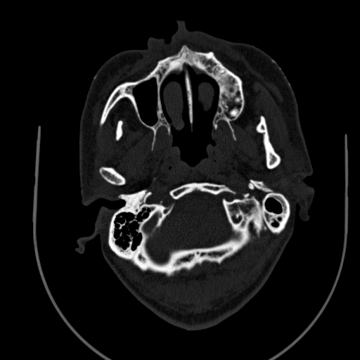 Chronic invasive fungal sinusitis (Radiopaedia 91563-109286 Axial sinus 1).jpg