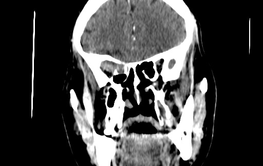Chronic invasive fungal sinusitis (Radiopaedia 91563-109286 D 61).jpg