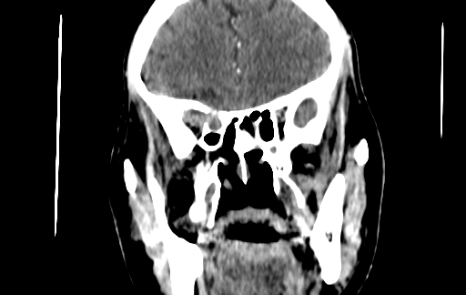 Chronic invasive fungal sinusitis (Radiopaedia 91563-109286 D 65).jpg